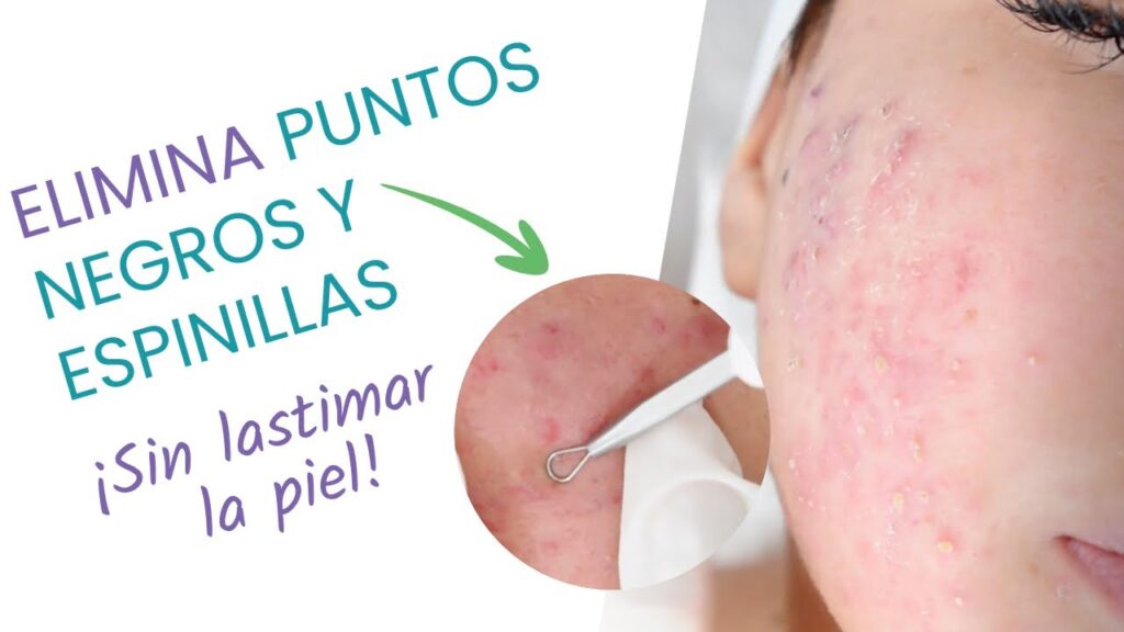 Espinilla interna: ¿Qué hacer y cómo sacarla? Guía completa del dermatólogo 1 espinilla interna que hacer y como sacarla guia completa del dermatologo