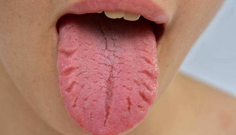 Lengua Agrietada y Diabetes: 3 Problemas de Salud que Puede Indicar 1 lengua agrietada y diabetes 3 problemas de salud que puede indicar