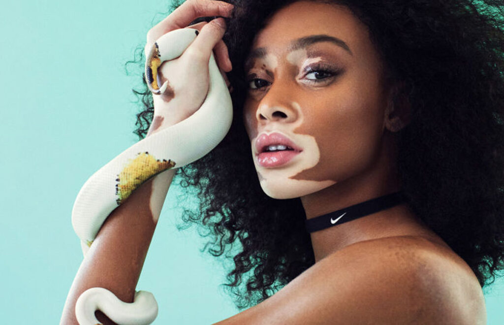 Modelos con Vitiligo: Rompiendo Estándares de Belleza 1 modelos con vitiligo rompiendo estandares de belleza