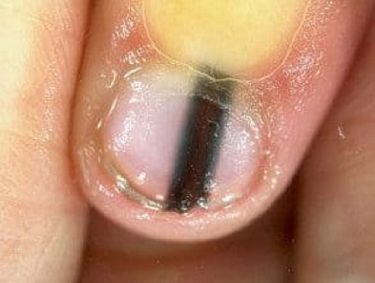 Fingernail Black Line: Alerta de Cáncer en Uñas y Melanoma 1 fingernail black line alerta de cancer en unas y melanoma
